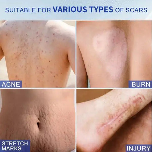 Silicone Scar Cream for Old and New Scars - Ummati_Essentials