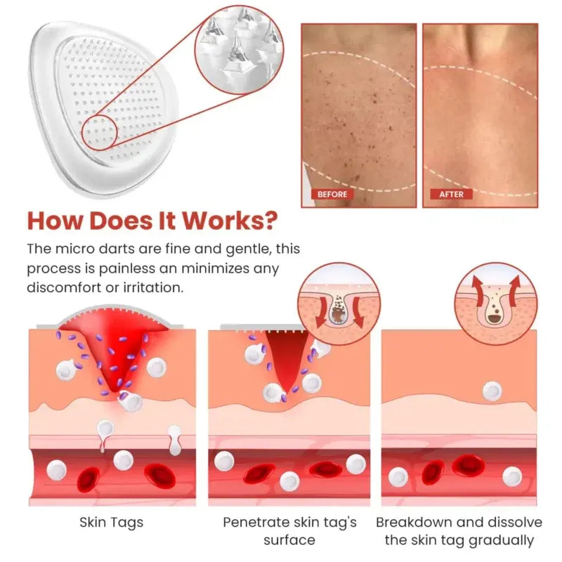 - Derma Smooth Skin Tag Removal Patch - ✨ 100% Results- Ummati Essentials