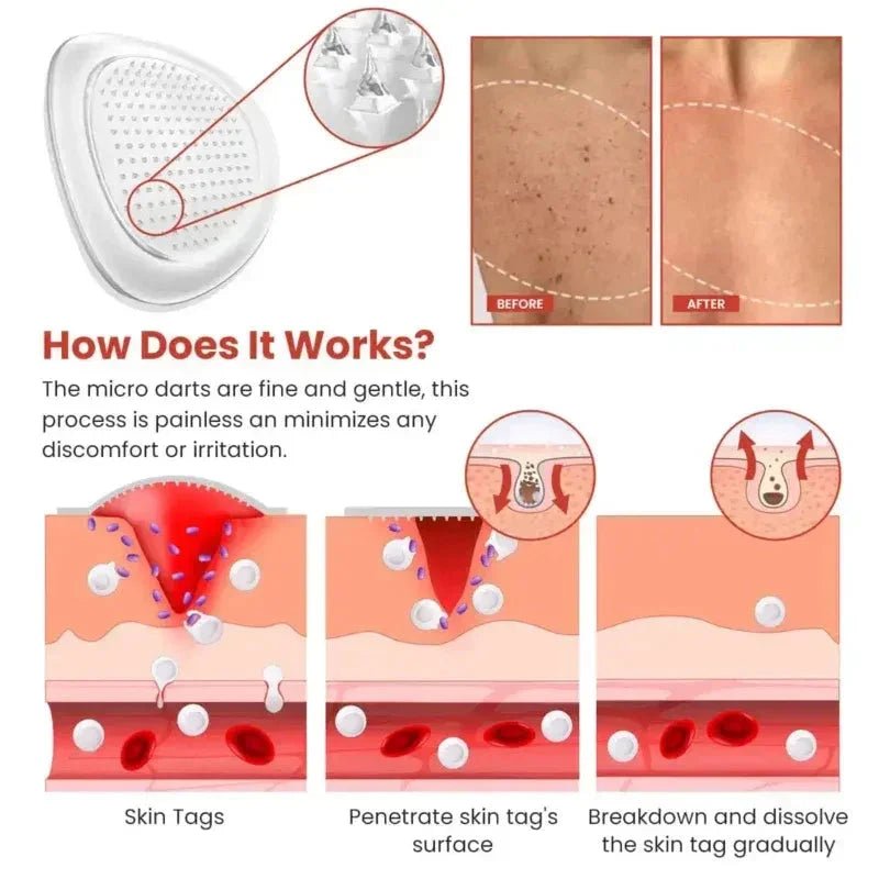 Derma Smooth Skin Tag Removal Patch - Ummati_Essentials