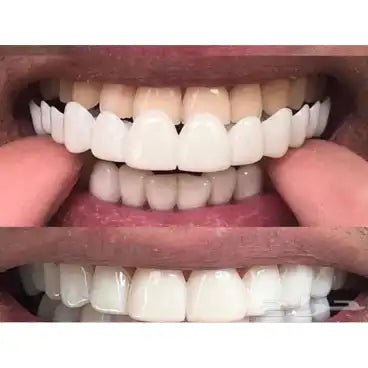 IMPORTED Snap-On Teeth Veneers - Ummati_Essentials